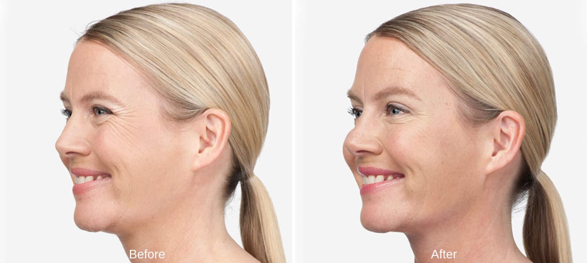 Improve the Lower Face